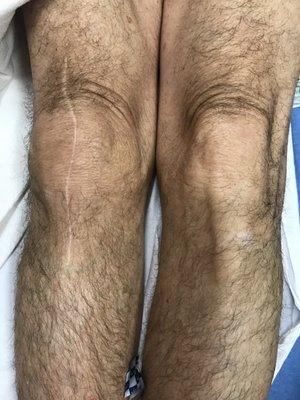 Replacement knee with scar is larger.