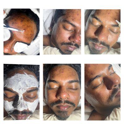 Collage of melanin safe acne treatment