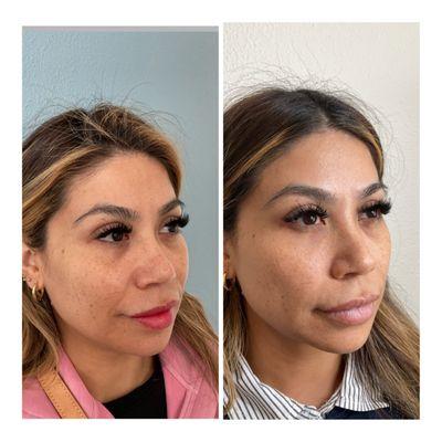 Clearlift Treatment
Botox/Daxxify treatment