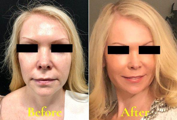 Vampire Facelift Before and After Mansfield TX