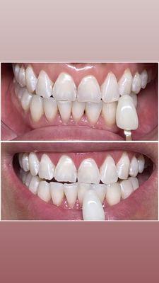 She comeback for a retouch after 6 months 30 min session