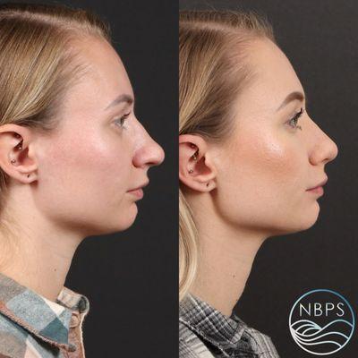 Rhinoplasty by Dr. Sailon