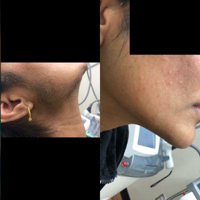 Laser hair removal picture before/ after four treatments six treatments required for better results