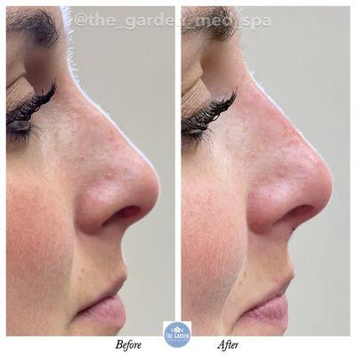Liquid Rhinoplasty!