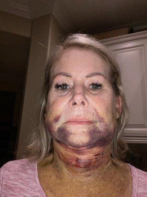 After procedure 8.5.22