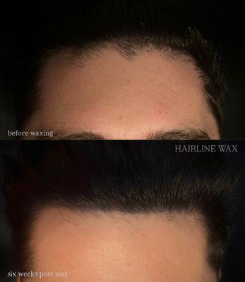 Hairline Wax:
above- before waxing
below- six weeks of hair growth after first wax