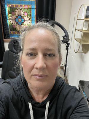 Before the lip treatment at Glo Med Spa.