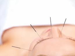 Acupuncture Lose Weight