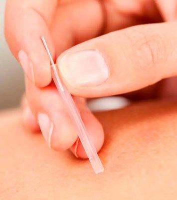 Acupuncture