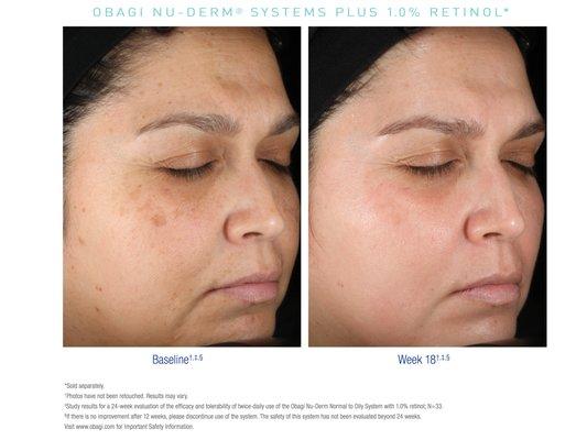 Improve fine lines, dark spots & uneven skin tone:
http://www.enhancedform.com/2018/03/14/obagi-fine-lines-uneven-skin-tone/