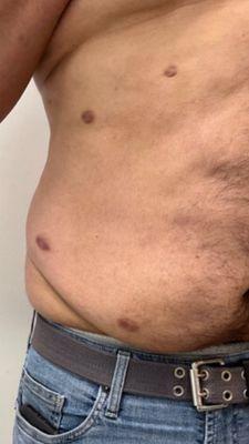Scars, lumpy, uneven liposuction.