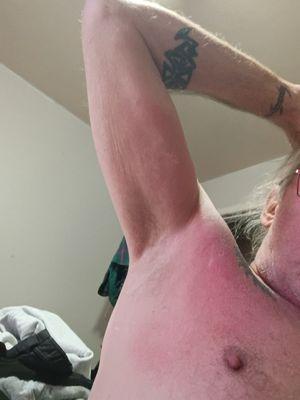 The aftermath of his work , I'm trying to stay out of the hospital yet save my life because of his unprofessional ! Please beware !