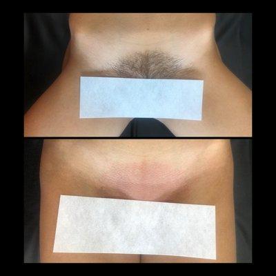 Before & After Brazilian Wax