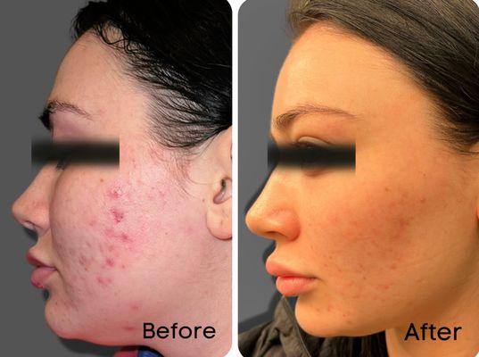 Before and After acne facial