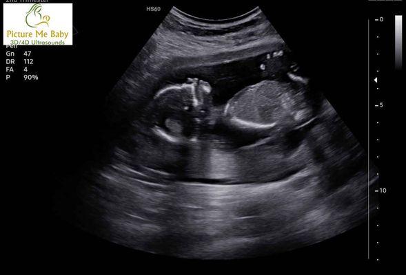 Baby L 15weeks Gender Ultrasound