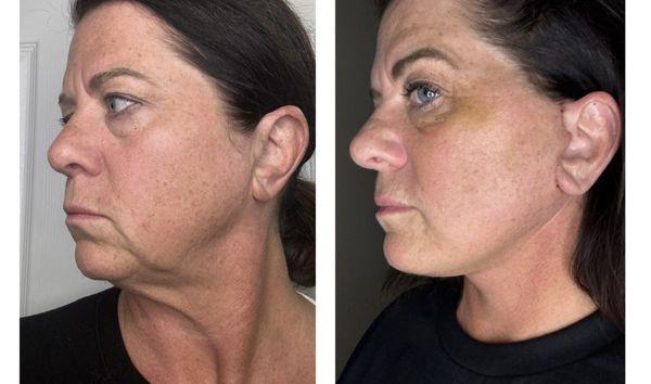 One week out from my Deep Plane Facelift. So thankful for the amazing results from Dr Cleveland!