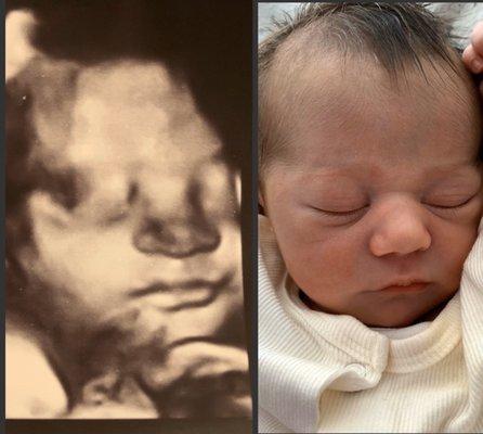 Isee baby ultrasound vs real life baby :)