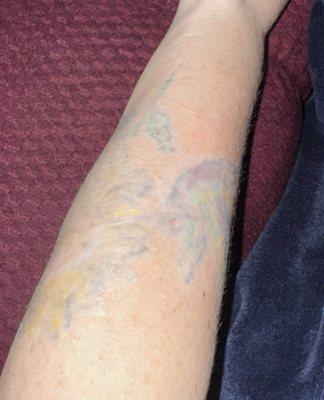 After 12+ laser removal sessions 