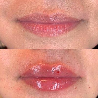 Lip Augmentation