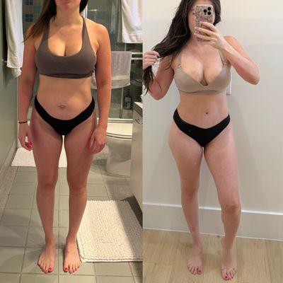 Tummy tuck with muscle repair. 6 weeks post operation.