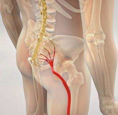 Sciatic nerve irritation