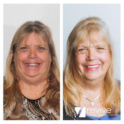 Revive Dental Implant Center. Mesa, AZ. Dental Implants