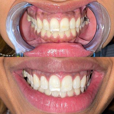 Brightens Teeth Whitening