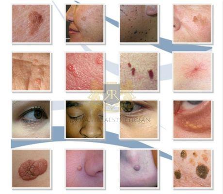 Skin irregularity removal using Radio Frequency