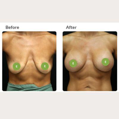 BREAST AUGMENTATION IN HUDSON, FLORIDA