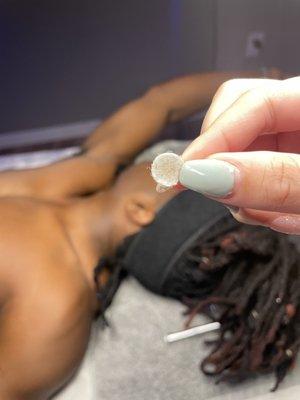 Microdermabrasion - all the Dead skin