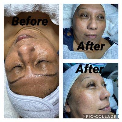 A light chemical peel can improve skin texture and tone,as well as decrease the appearance of wrinkles.