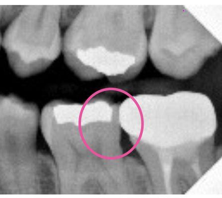 Over shaven tooth to make crown fit. Bad work by a so called "dentist" Dr. Martinez