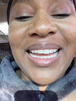 One tooth shorter than the other . The male hygienist said he made it shorter "on purpose " .