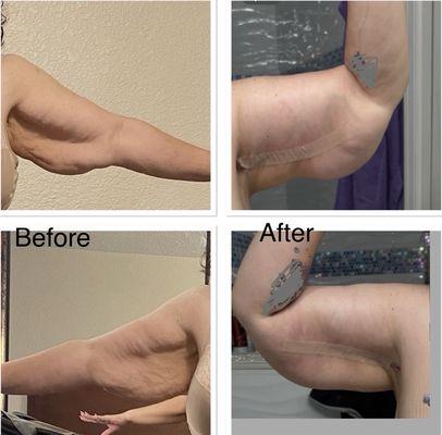 Brachioplasty, Lipo, arm lift