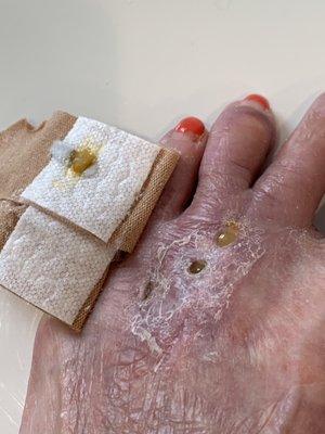 Foot surgery May 3 by Dr Katchis followed by pain and infection and hospitalization and IVs through now, 9/4/19.