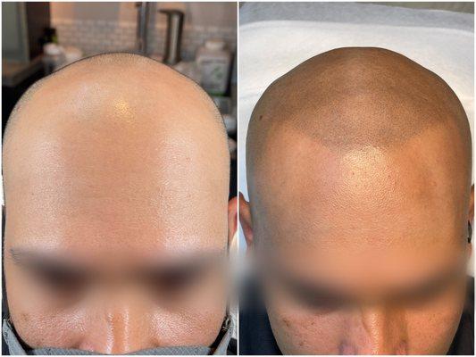 Dermalux Repigmentation Clinic
