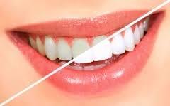 Epic Laser Teeth Whitening.  Fast. Safe. Effective. Less Sensitivity.