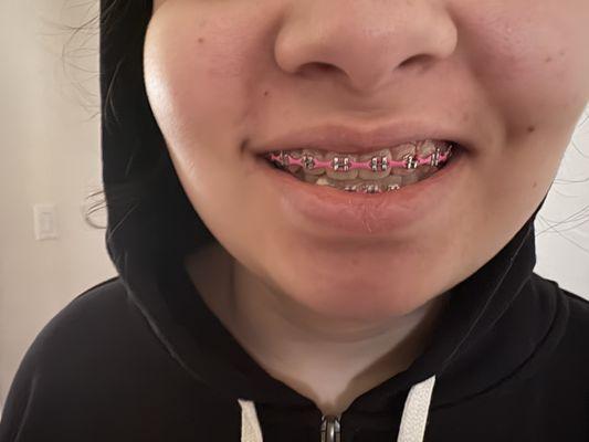Anita braces
