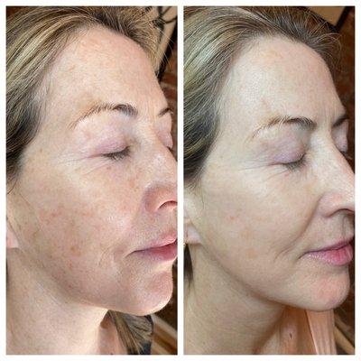 Lumecca IPL for sun damage (1 treatment)