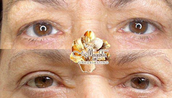 Upper eye lift