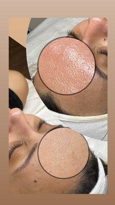 Decongesting your pores in every facial treatment.