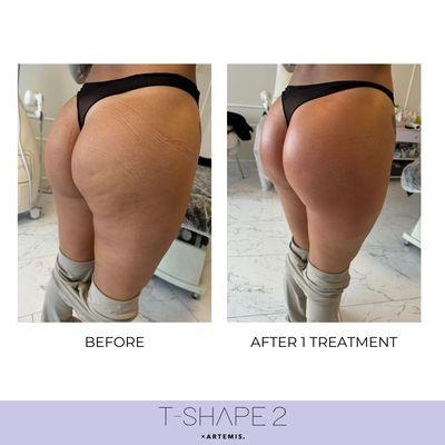 Before and After 1 T-Shape 2 treatment
