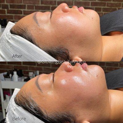 Dermaplane + HydraFacial
..
Want glowing skin? This is the perfect combo for that.