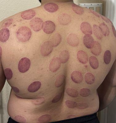 Cupping therapy
