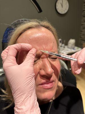 Botox injections for wrinkle reduction