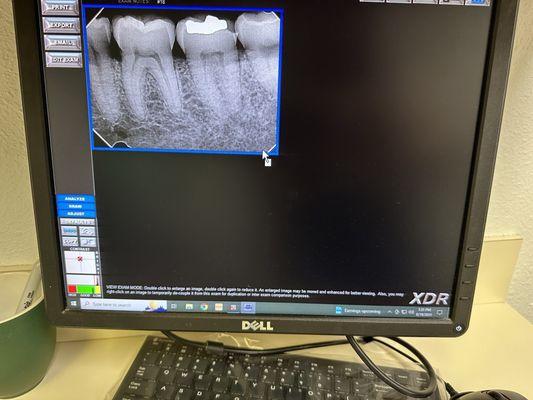Dental X-ray