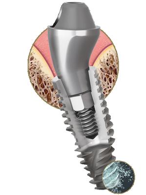 Dental Implant