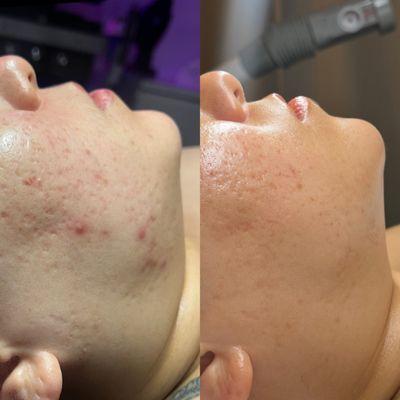 Before and after skin transformation