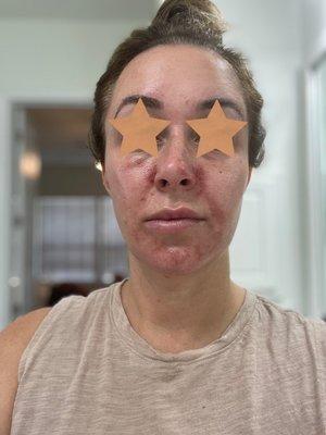 Scabs, swelling, burning