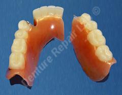 Broken partial denture